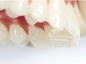 Preview: Puntas de recambio Tiger Dental MiniMold (molde de mordida palatina)