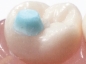 Preview: MiniMold System, Piezas de mordida molares