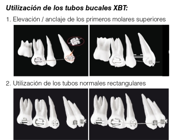 Tubos bucales adhesivos XBT para el enderezamiento / anclaje del 1° molar, MS