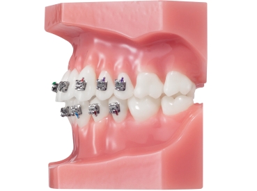 YES™ active, Brackets individuales, MBT* .022"