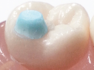 MiniMold System, Piezas de mordida molares